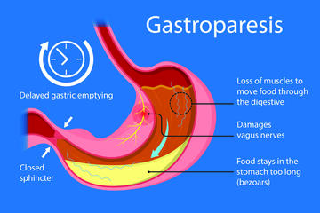 Gastroparesis illustration. Text: Loss of muscles to move food through the digestive. Damages vagus nerves. Food stays in the stomach too long (bezoars). Closed sphincter. Delayed gastric emptying.