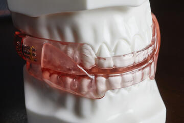 dental appliance on a model of teeth