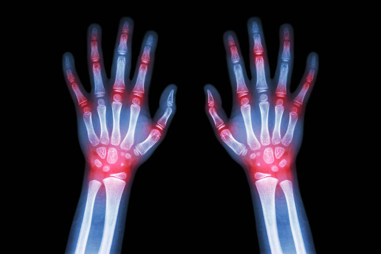 X-Ray image of two hands with joint areas highlighted in red.