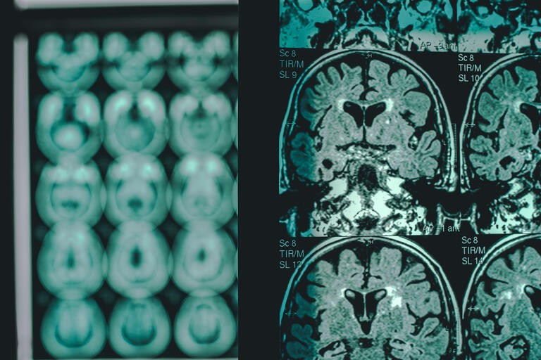 MRI scan of a brain with Alzheimer's disease.